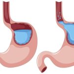 Trào Ngược Dạ Dày: Nguyên Nhân, Biến Chứng & Cách Điều Trị