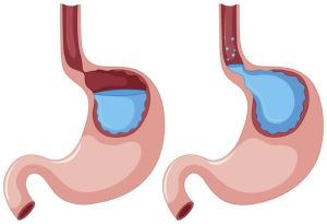 Trào ngược dạ dày là bệnh lý về tiêu hóa rất thường gặp