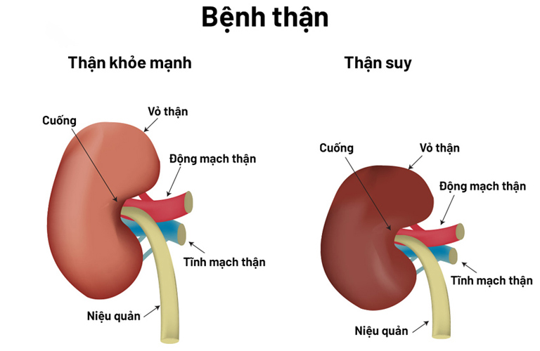 Sỏi gây tắc nghẽn đường tiết niệu kéo dài có thể dẫn đến suy thận