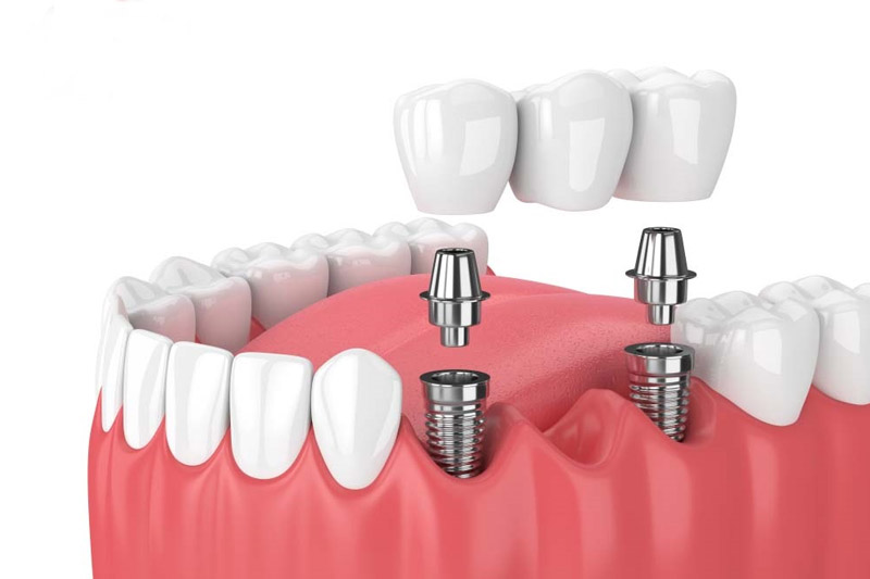 Trồng răng Implant là kỹ thuật cấy trụ Titanium vào xương hàm