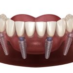 Trồng Răng Implant Là Gì? Ưu Nhược Điểm, Chi Phí