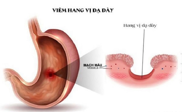 viem-hang-vi-1