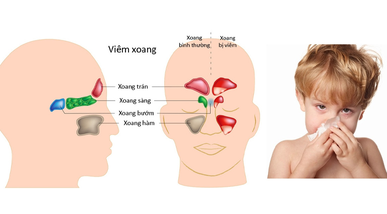 Trẻ em là đối tượng dễ mắc bệnh viêm xoang bướm