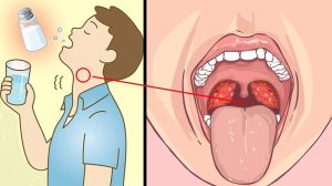 Viêm Amidan Có Nên Ngậm Nước Muối? Giải Đáp