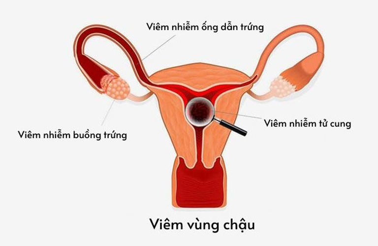 Viêm vùng chậu rất khó có thai nhưng không phải không thể