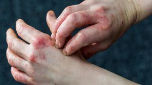 Bệnh Eczema Có Lây Không? Phòng Bệnh Như Thế Nào?