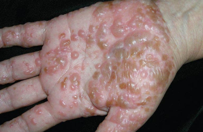 Bệnh tổ đỉa (eczema dyshidrotic) là một dạng viêm da dị ứng đặc trưng bởi các mụn nước nhỏ, gây ngứa