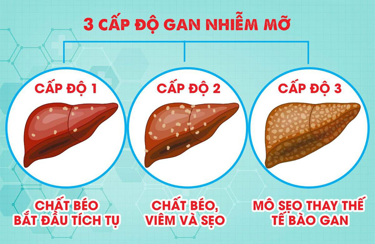 Gan nhiễm mỡ độ 1 với khoảng 5-10% lượng mỡ trong gan