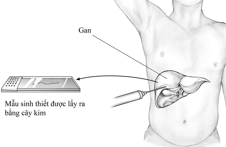 Sinh thiết gan chỉ được chỉ định trong các trường hợp nghi ngờ gan nhiễm mỡ độ nặng