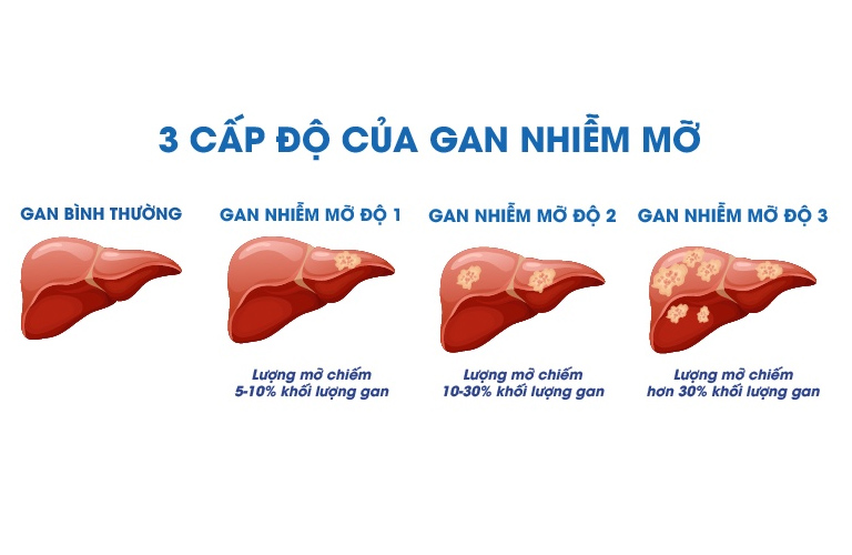 Gan nhiễm mỡ độ 3 là giai đoạn cuối cùng và nặng nhất của bệnh gan nhiễm mỡ