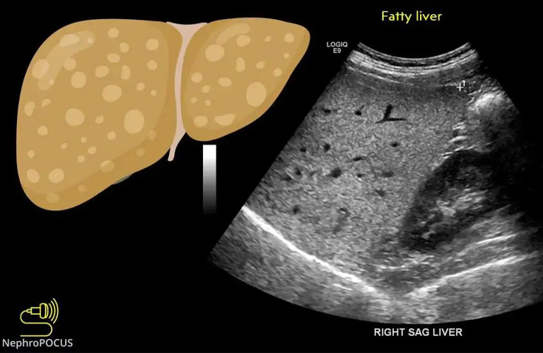 Siêu âm gan giúp đánh giá kích thước, cấu trúc gan và mức độ nhiễm mỡ