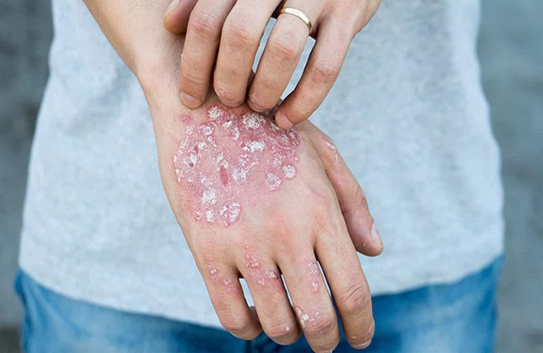 Bệnh chàm Eczema