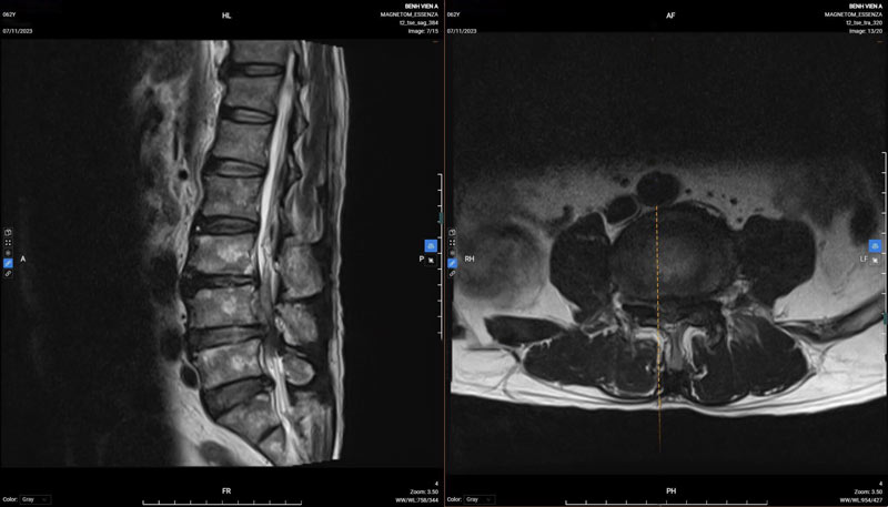 Hình chụp thoát vị đĩa đệm cột sống thắt lưng L4, L5 trên bệnh nền u gan của bệnh nhân T.