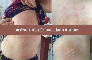 dị ứng thời tiết bao lâu thì khỏi