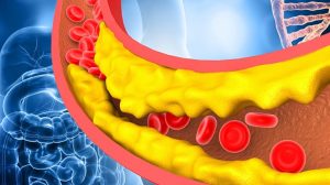 LDL Cholesterol Cao: Hiểu Rõ Nguy Cơ Và Cách Kiểm Soát