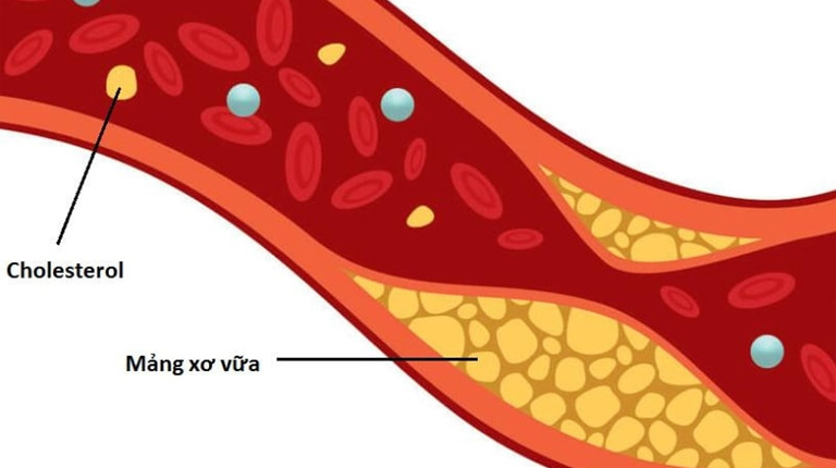 LDL Cholesterol cao là tình trạng nồng độ lipoprotein tỷ trọng thấp (LDL) vượt quá ngưỡng bình thường trong máu