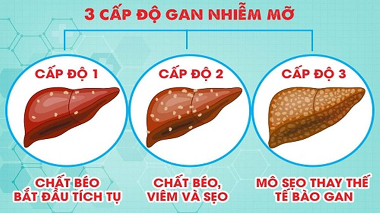 Các cấp độ gan nhiễm mỡ