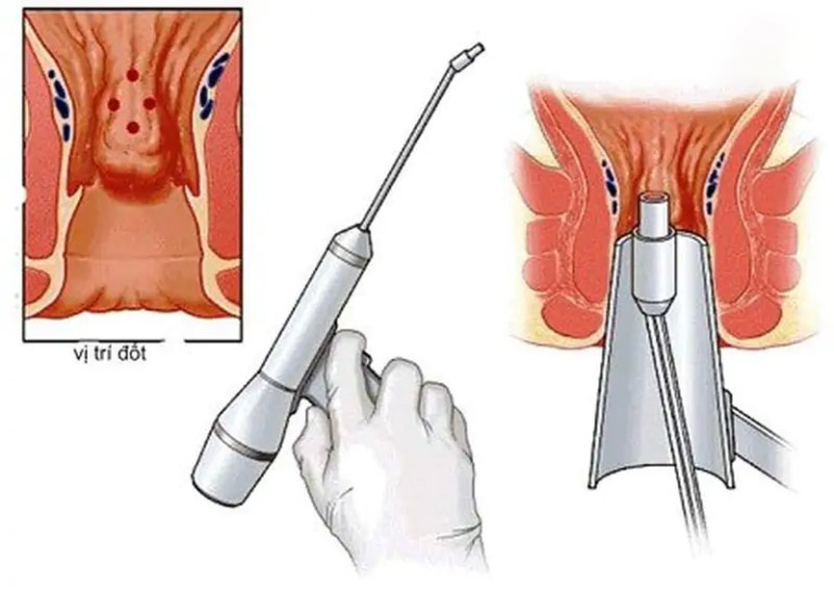 Bác sĩ điều trị viêm lộ tuyến cổ tử cung