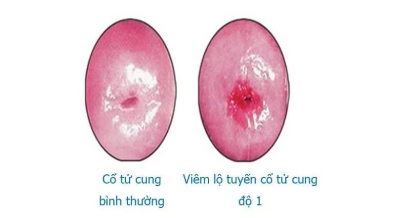 viem-lo-tuyen-do-1 (1)