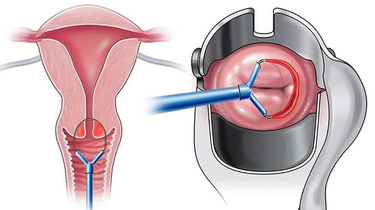 Sinh thiết cổ tử cung là cách thức chẩn đoán viêm lộ tuyến chính xác