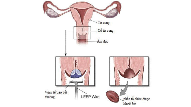 Đốt điện (LEEP) là kỹ thuật điều trị thực hiện nhanh chóng, ít đau đớn