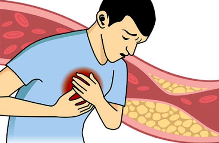 Triglyceride cao làm tăng nguy cơ xơ vữa động mạch, dẫn đến các bệnh lý tim mạch như đau thắt ngực