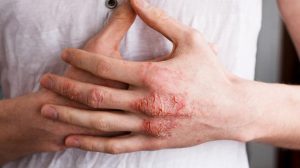 Bệnh Eczema Có Chữa Khỏi Được Không?