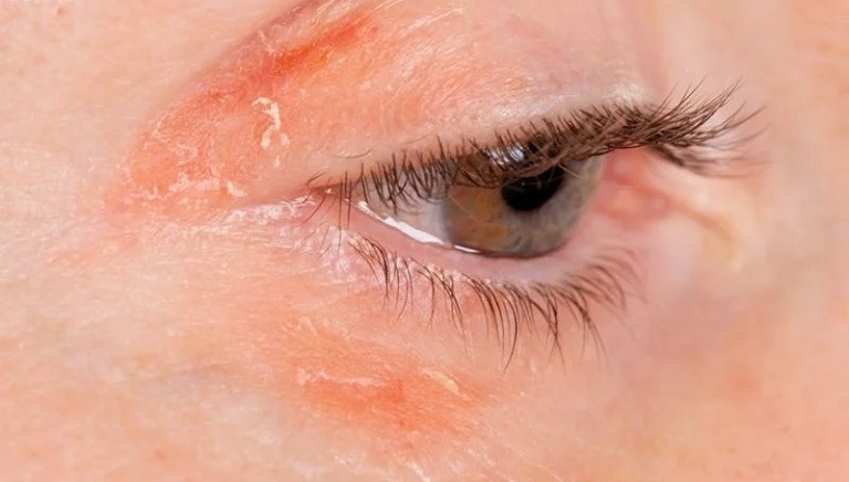 Nổi mẩn đỏ quanh mắt là tình trạng vùng mắt xuất hiện các nốt đỏ, sưng và ngứa