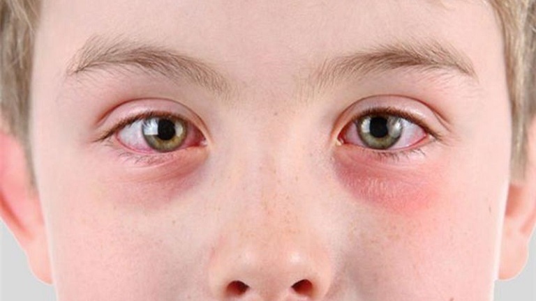 Trẻ em, trẻ sơ sinh là đối tượng dễ bị nổi mẩn đỏ xung quanh mắt