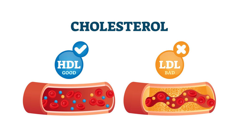 Cholesterol gồm 2 loại là cholesterol tốt và xấu