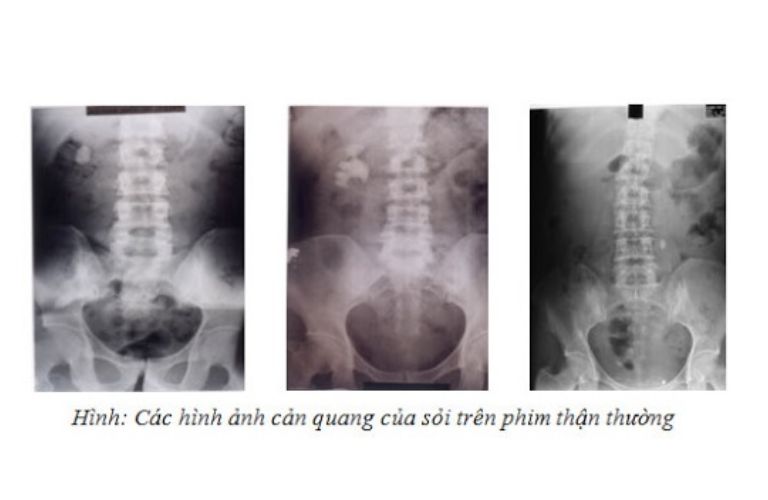 Kỹ thuật này cho phép phát hiện cả sỏi cản quang và sỏi không cản quang