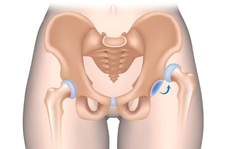 Quá trình sinh nở khó khăn có thể gây trật khớp háng