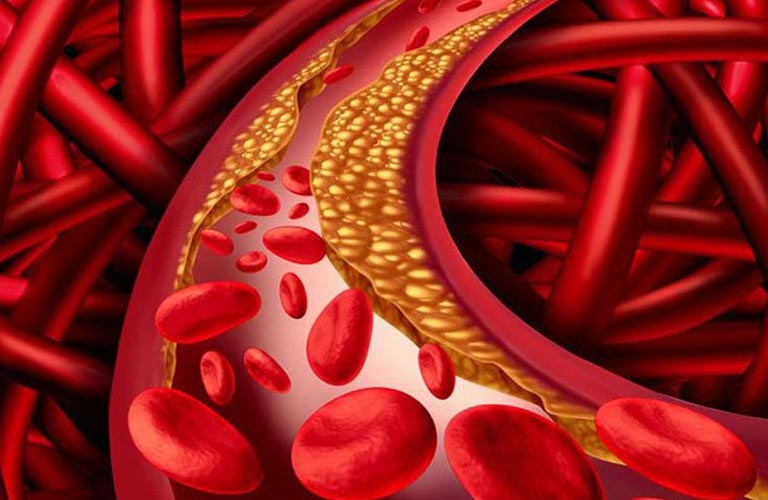 Mỡ máu cao, còn được gọi là tăng cholesterol hoặc rối loạn lipid máu