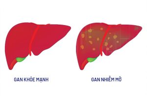 Gan Nhiễm Mỡ Độ 1: Cách Chẩn Đoán Và Điều Trị