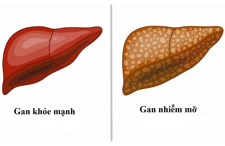 gan-nhiem-mo-va-mau-nhiem-mo