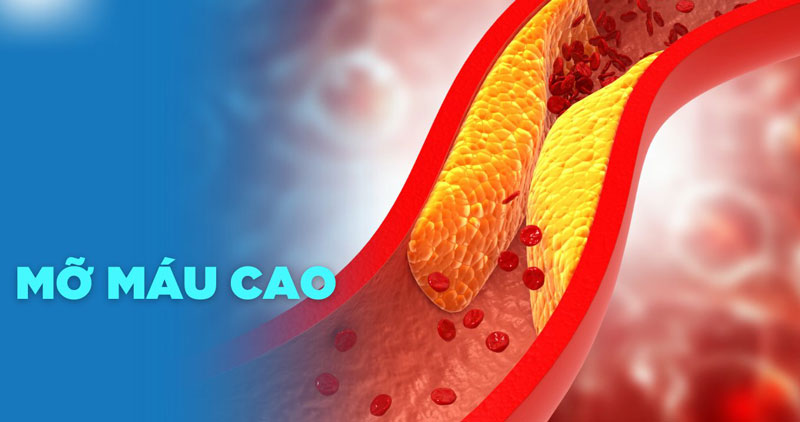 Mỡ máu cao, hay rối loạn lipid máu, là một vấn đề sức khỏe phổ biến, đặc biệt ở những người có lối sống ít vận động