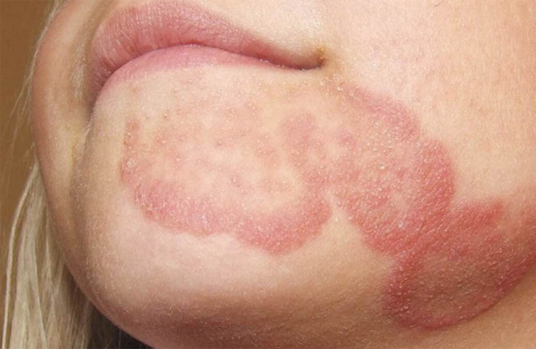 Bệnh hắc lào do các loại nấm thuộc nhóm dermatophytes gây ra