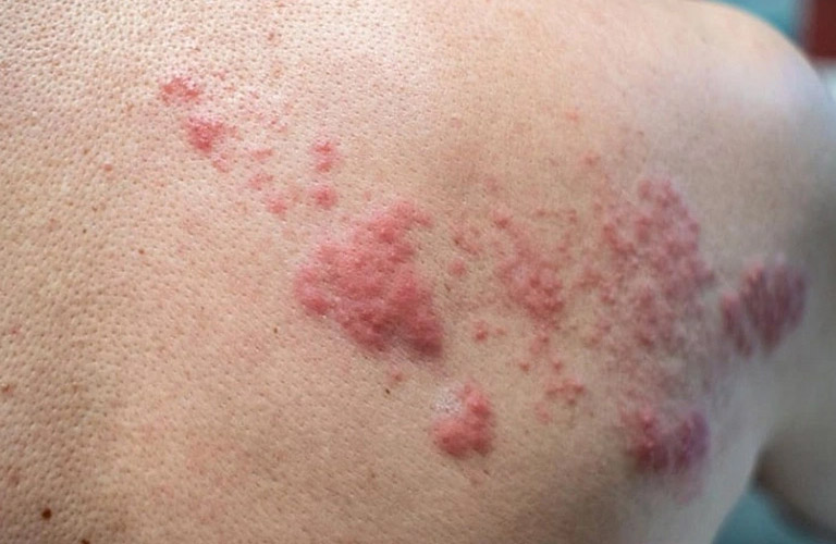 Chàm bội nhiễm là tình trạng da bị chàm bị nhiễm trùng do vi khuẩn, virus hoặc nấm