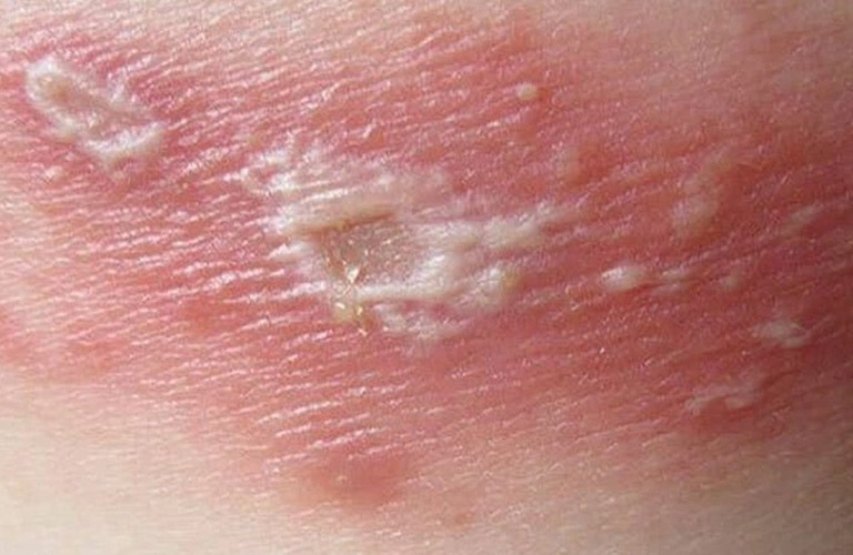 Chàm bội nhiễm có thể do nhiều nguyên nhân gây nên