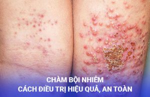 chàm bội nhiễm