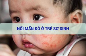 nổi mẩn đỏ ở trẻ sơ sinh