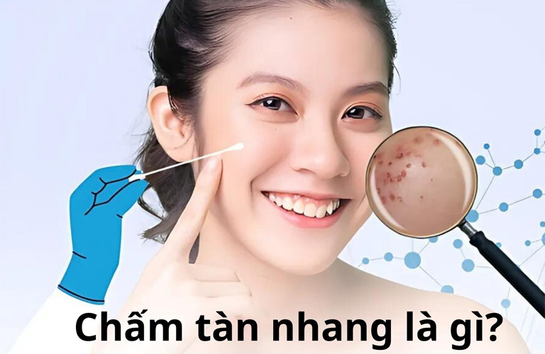 Thuốc chấm tàn nhang là những sản phẩm được bào chế đặc biệt để đánh bay nết nám, tàn nhang