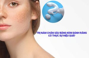 Trị Nám Chân Sâu Bằng Kem Đánh Răng