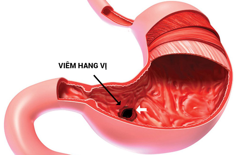 Viêm hang vị dạ dày