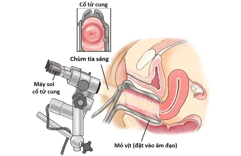 Soi cổ tử cung là cách chẩn đoán bệnh chính xác