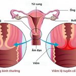 Viêm Lộ Tuyến Cổ Tử Cung: Nguyên Nhân, Dấu Hiệu Và Cách Điều Trị