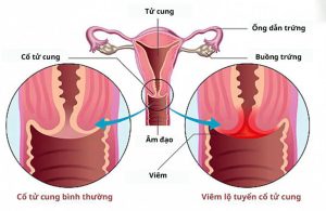 Viêm lộ tuyến cổ tử cung