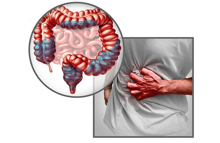 Hội Chứng Ruột Kích Thích: Triệu Chứng, Cách Điều Trị