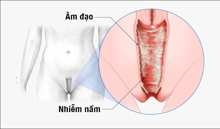 Nấm âm đạo là tình trạng nhiễm trùng xảy ra do sự phát triển quá mức của nấm Candida