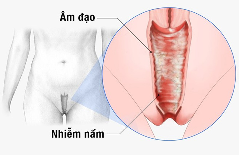 Nấm âm đạo khi mang thai là tình trạng khá phổ biến